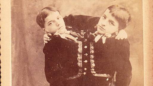 Nejznámější siamská dvojčata historie i současnosti: Většina z nich musela celý život zůstat v jednom těle
