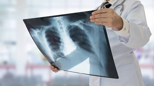 Tuberkulóza: jak jí předcházet a zmírnit její příznaky