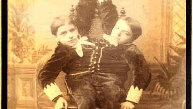 Dvouhlavý chlapec aneb siamská dvojčata Giacomo a Giovani