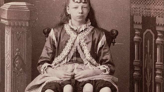 Čtyřnohá dívka z Texasu: Tuto přezdívku si vysloužila Myrtle Corbinová narozená 12. 5. 1868